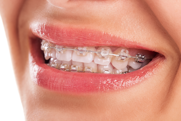 The Convenience Of Clear Braces In Albuquerque