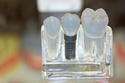 We Offer Implant Supported Dentistry To Expand Your Options