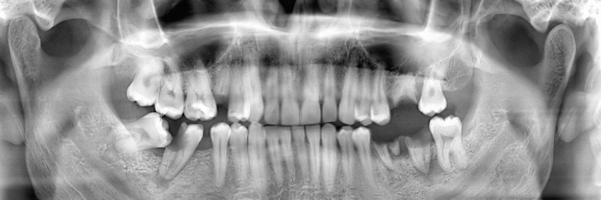 Albuquerque Options for Replacing Missing Teeth